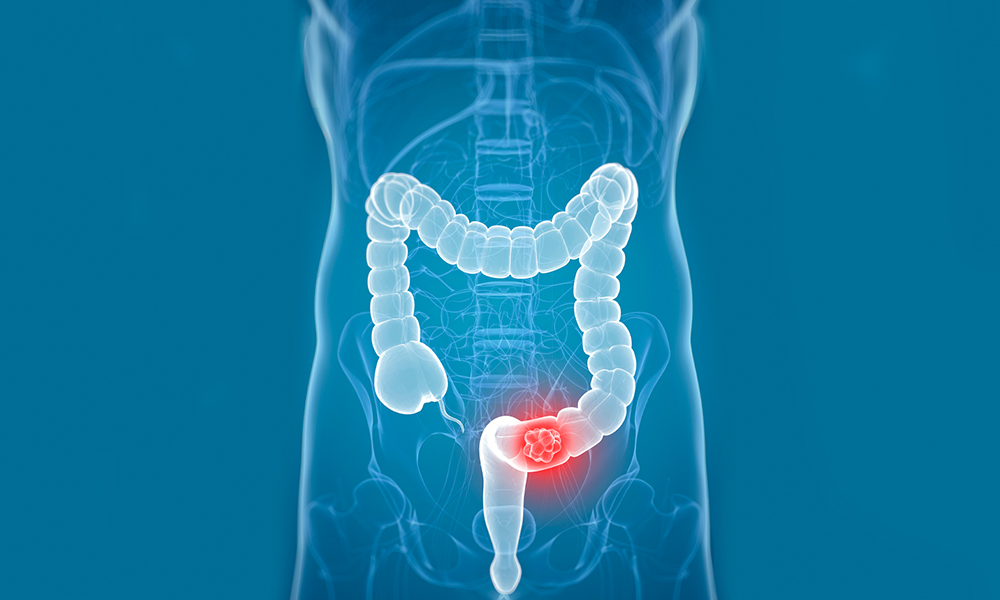 Surgery for Colorectal Cancer